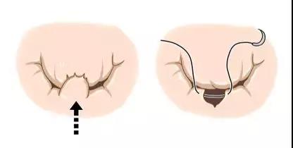 瓣膜尖切除