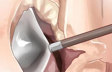 利用自體心包膜的主動脈瓣重建手術(shù)