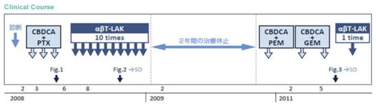 免疫細胞治療之晚期非小細胞肺癌