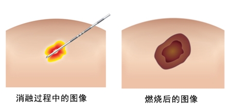 早期乳腺癌：無需手術 射頻消融治療成為微創新療法，已納入日本醫保