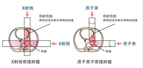 質子重離子治療優勢1
