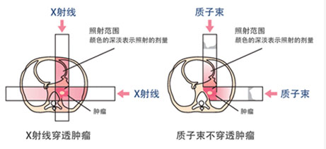 質子重離子治療優勢4